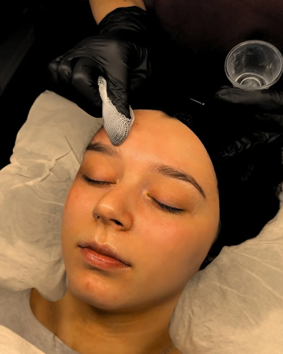 Chemical Peel