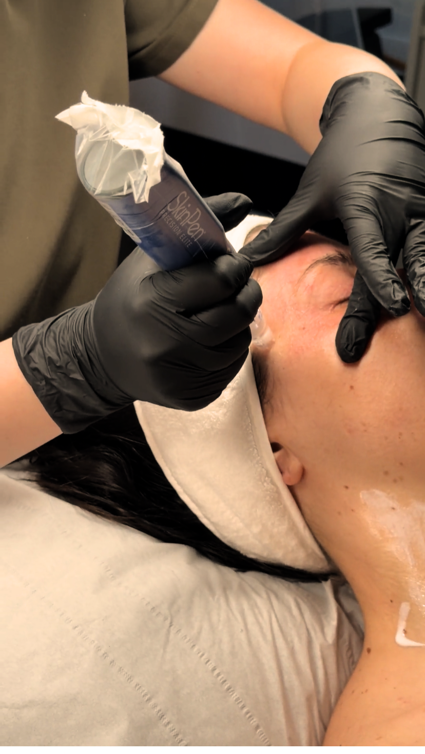 SkinPen Microneedling 